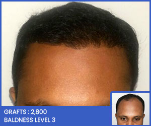 Hair Transplant in Lucknow - Affordable Cost, Assured Results